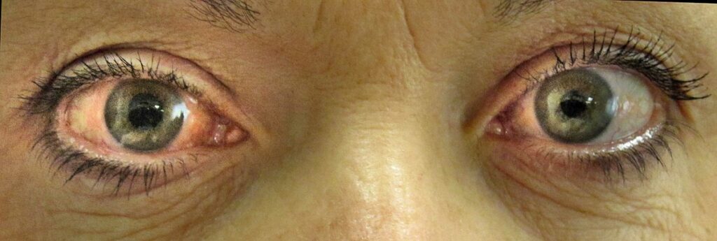 1200px Acute angle closure glaucoma
